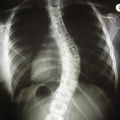 gerincferdülés ismeretlen